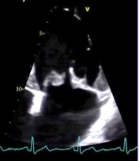 <p>Degenerative thickening of the MV leaflets.</p><p>Can be mistaken for a mass.</p>