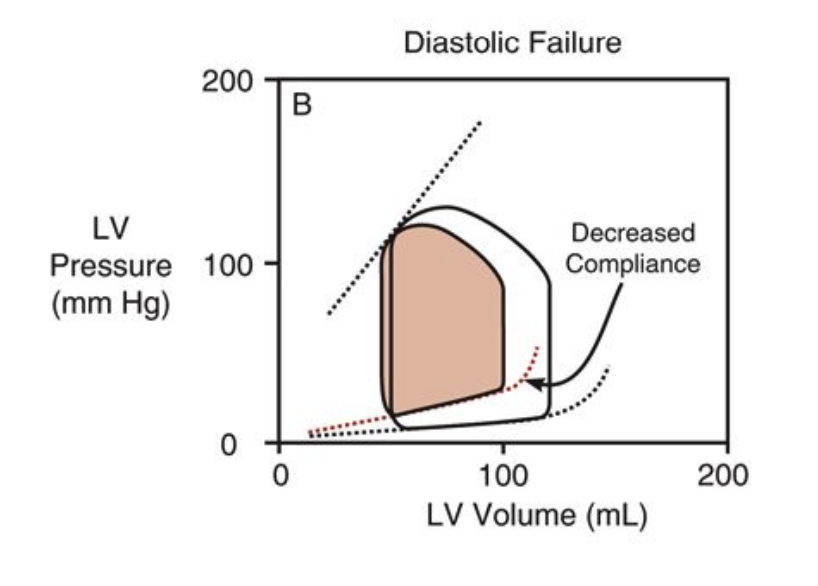 <ul><li><p>dpending upon the relative change in sv and edsv the ejection fraction might not chnange = ejection fraction is only useful as an indicator of systolic falieure</p></li></ul><p>elevated diastolic pressures = pulminary edima (increased afterload)</p><p>peerhiperal edima and abodminal sceites with r ventricular flaure</p><p></p>