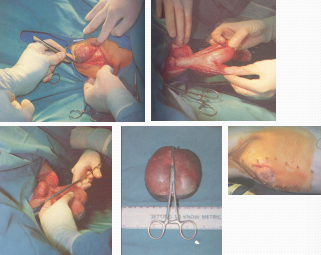 <p>Preputial Diverticulum in <span style="color: rgb(230, 155, 255)">pigs</span></p>