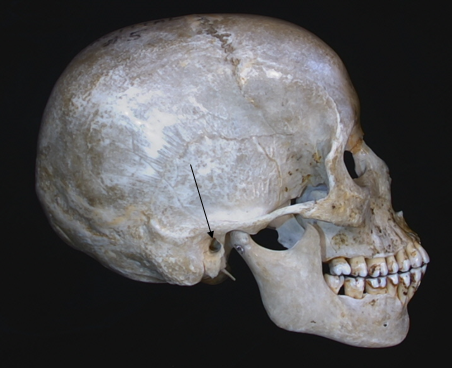 external auditory meatus 