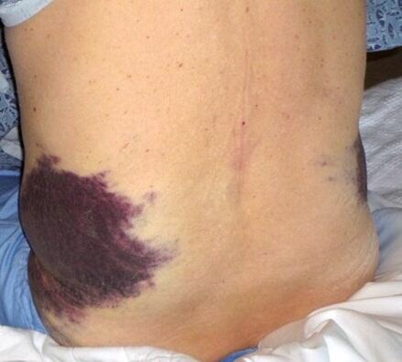 <p>retroperitoneal bleeding</p>