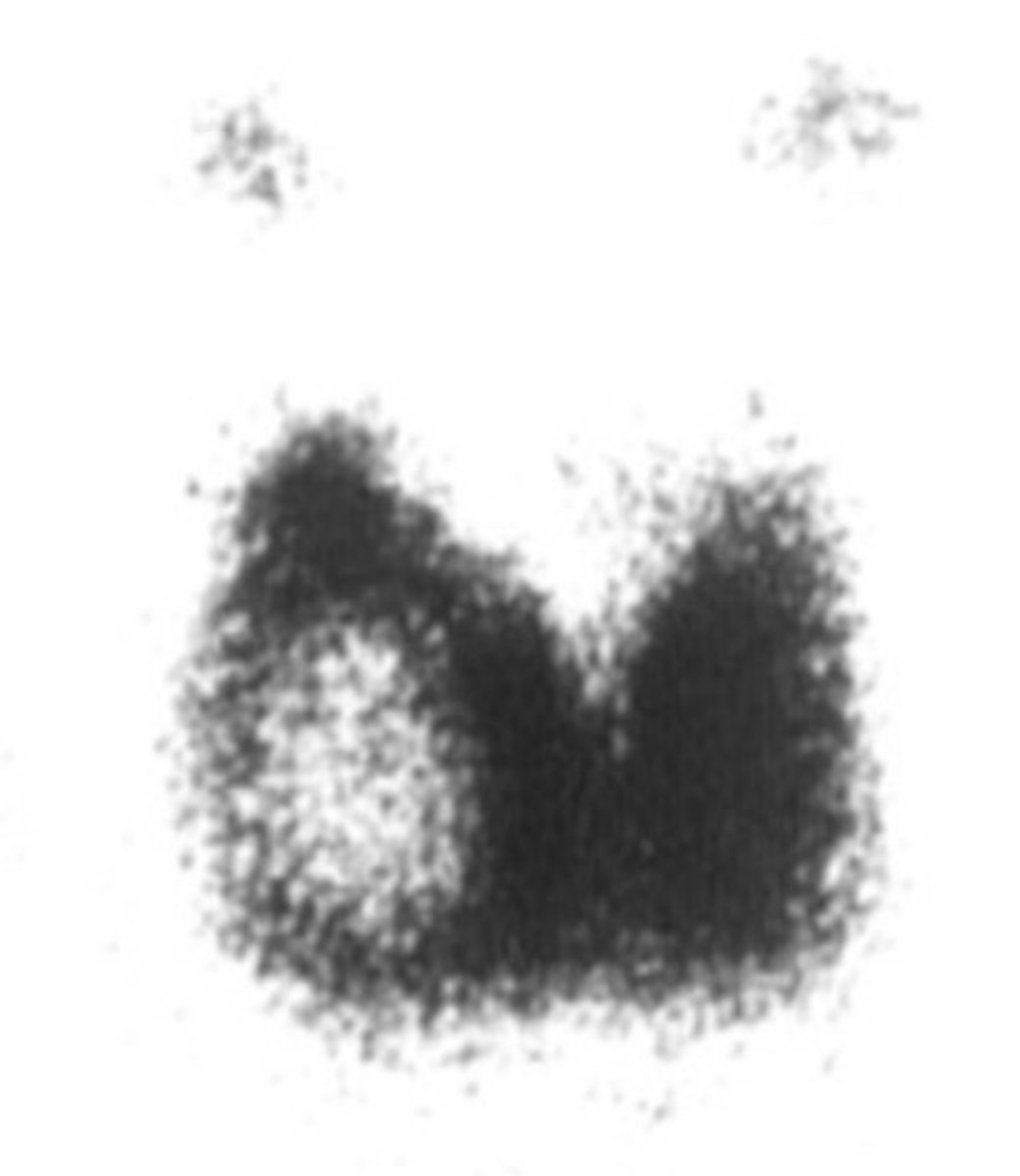 <p>RAIU finding on follicular carcinoma</p>
