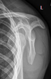 <p>is this a normal or dislocated shoulder? in which direction is it dislocated?</p>