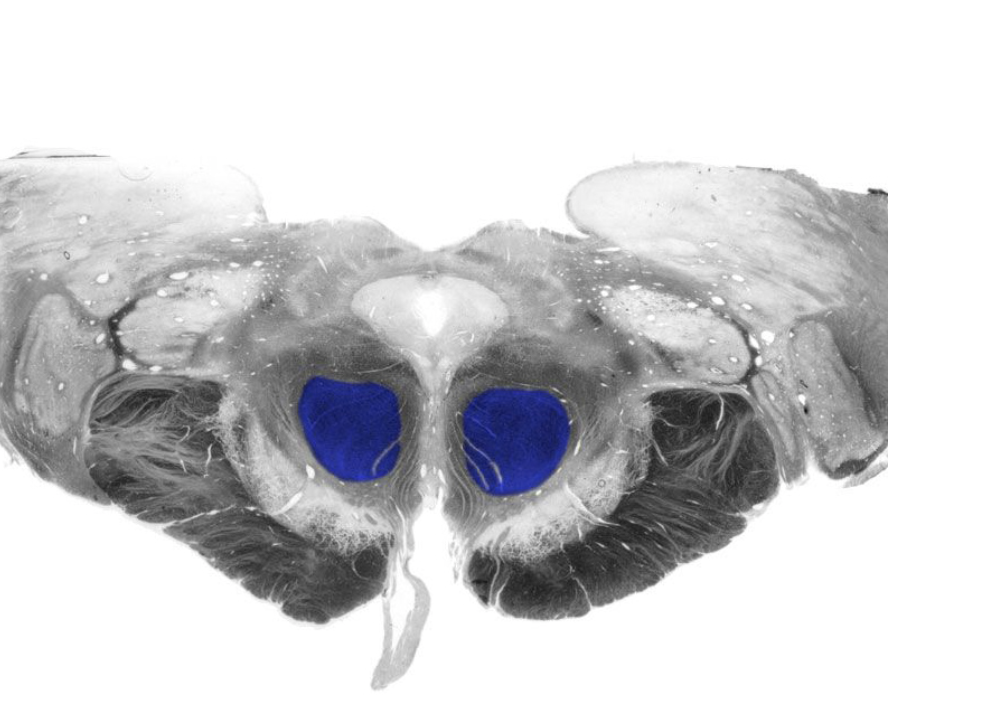 <p>Prominent nucleus located in the tegmentum of the rostral midbrain. Its major parvocellular (small-celled) division conveys signals from the cerebral cortex to the inferior olivary nucleus, which in turn modulates activity in the cerebellum. A minor magnocellular (large-celled) division may contribute to the control of the distal upper extremities via projections to the lateral ventral horn of the spinal cord, projections that form the rubrospinal tract; however, this projection is vestigial and variable in humans and its functional significance is uncertain.</p>