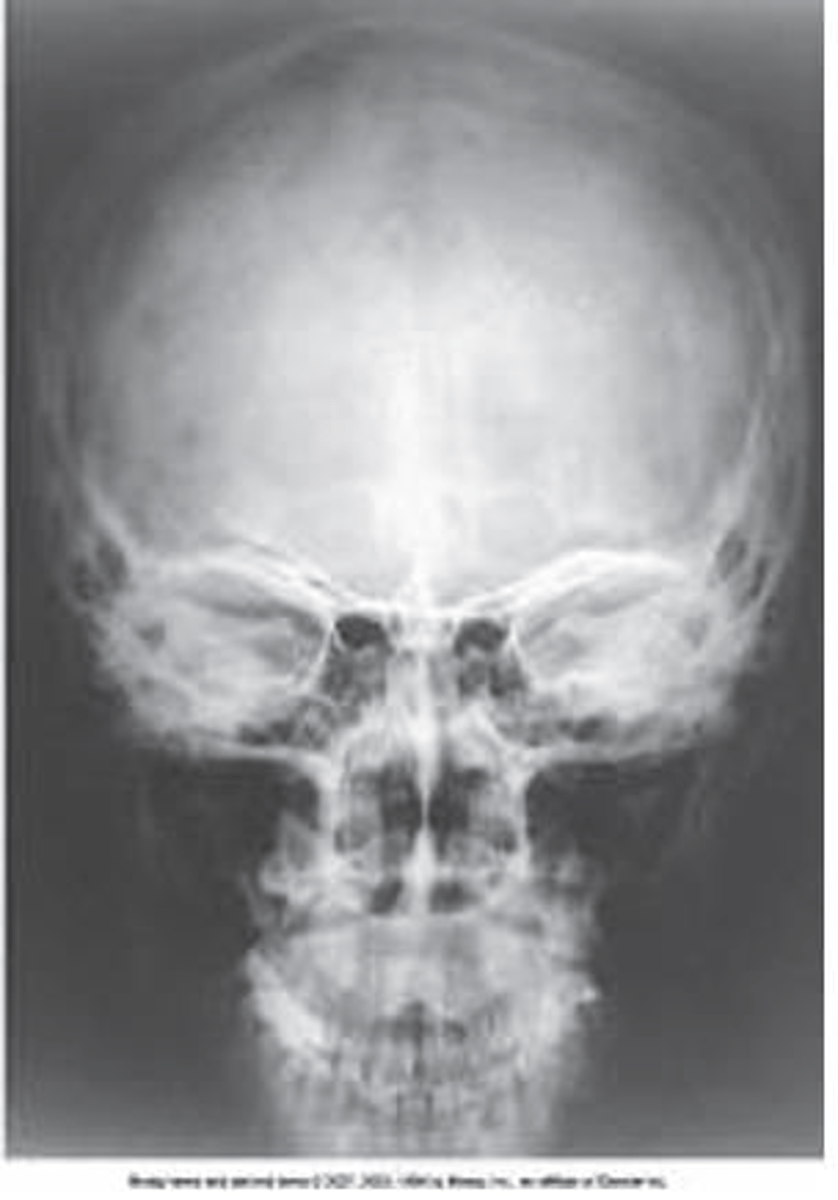 <p>a. Perpendicular</p>