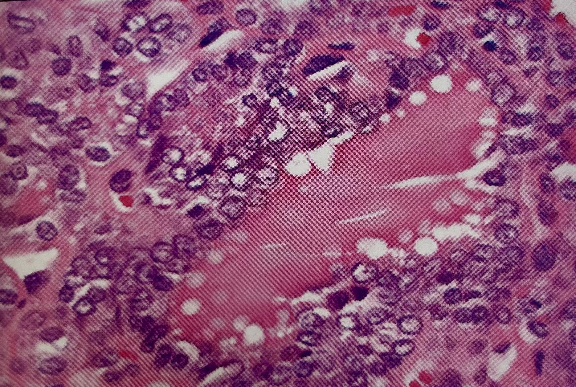 <p>The nuclear problem seen in this image is most often attributed to:</p><p>a. delay in fixation</p><p>b. incomplete fixation</p><p>c. overdehydration</p><p>d. poor paraffin infiltration</p>