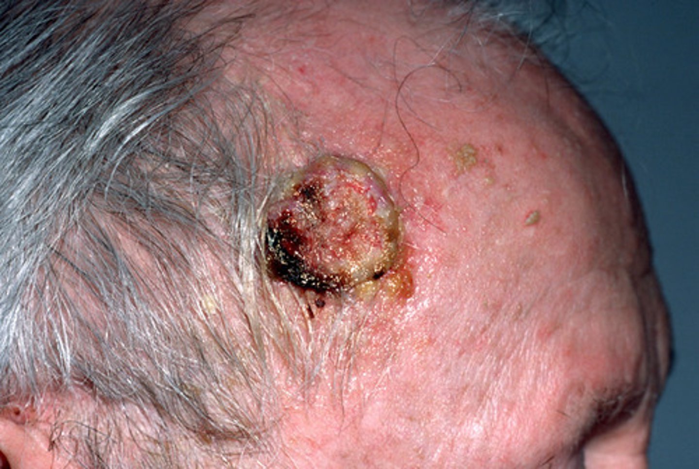 <p>Skin cancer arising in the upper layer of the epidermis; usually crusty, scaly, red, inflamed or ulcerated; can metastasize</p>