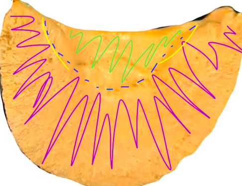 this is the sole of the distal phalanx. the line in blue is called