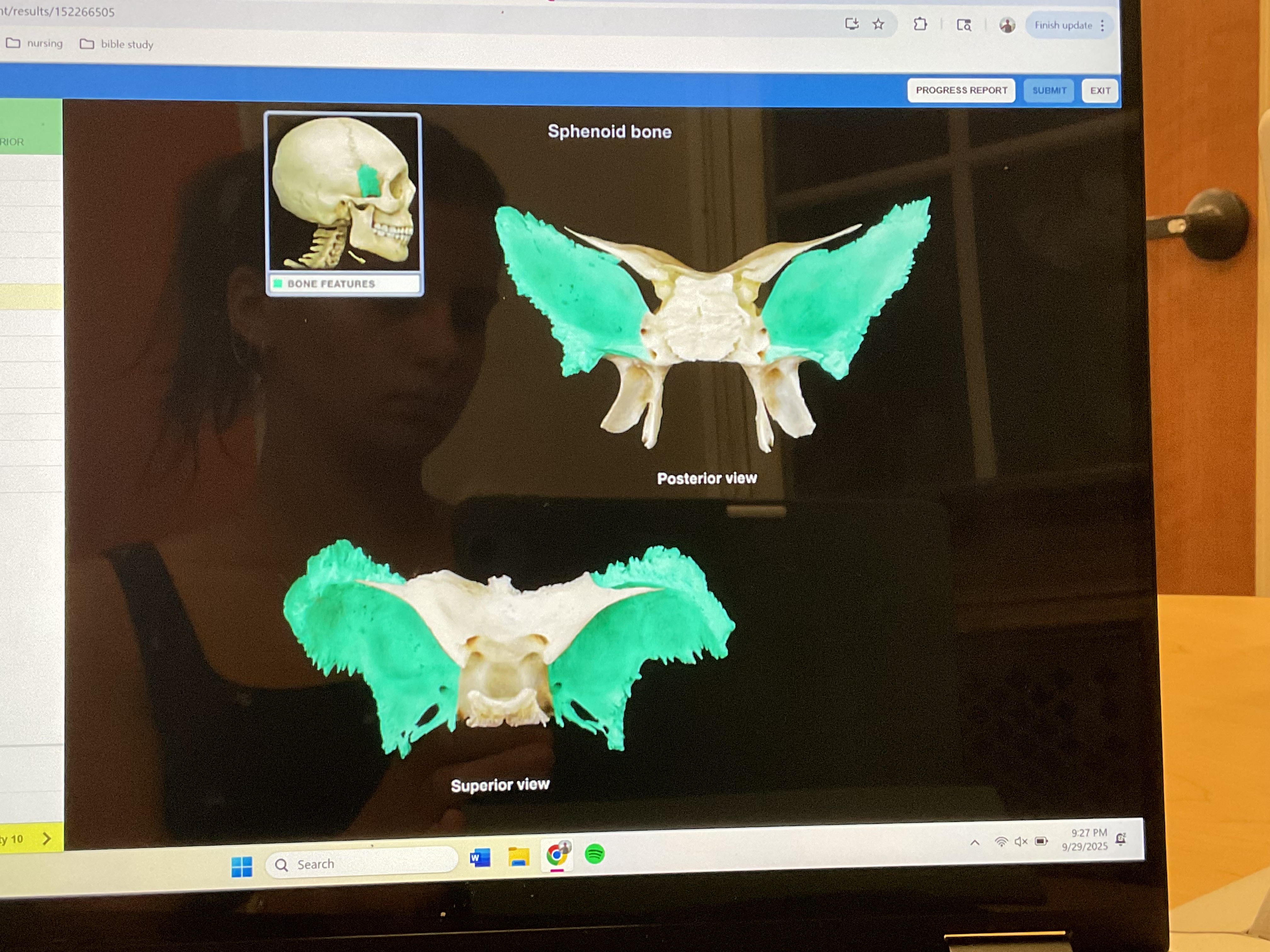 <p>Greater wing of sphenoid bone </p>