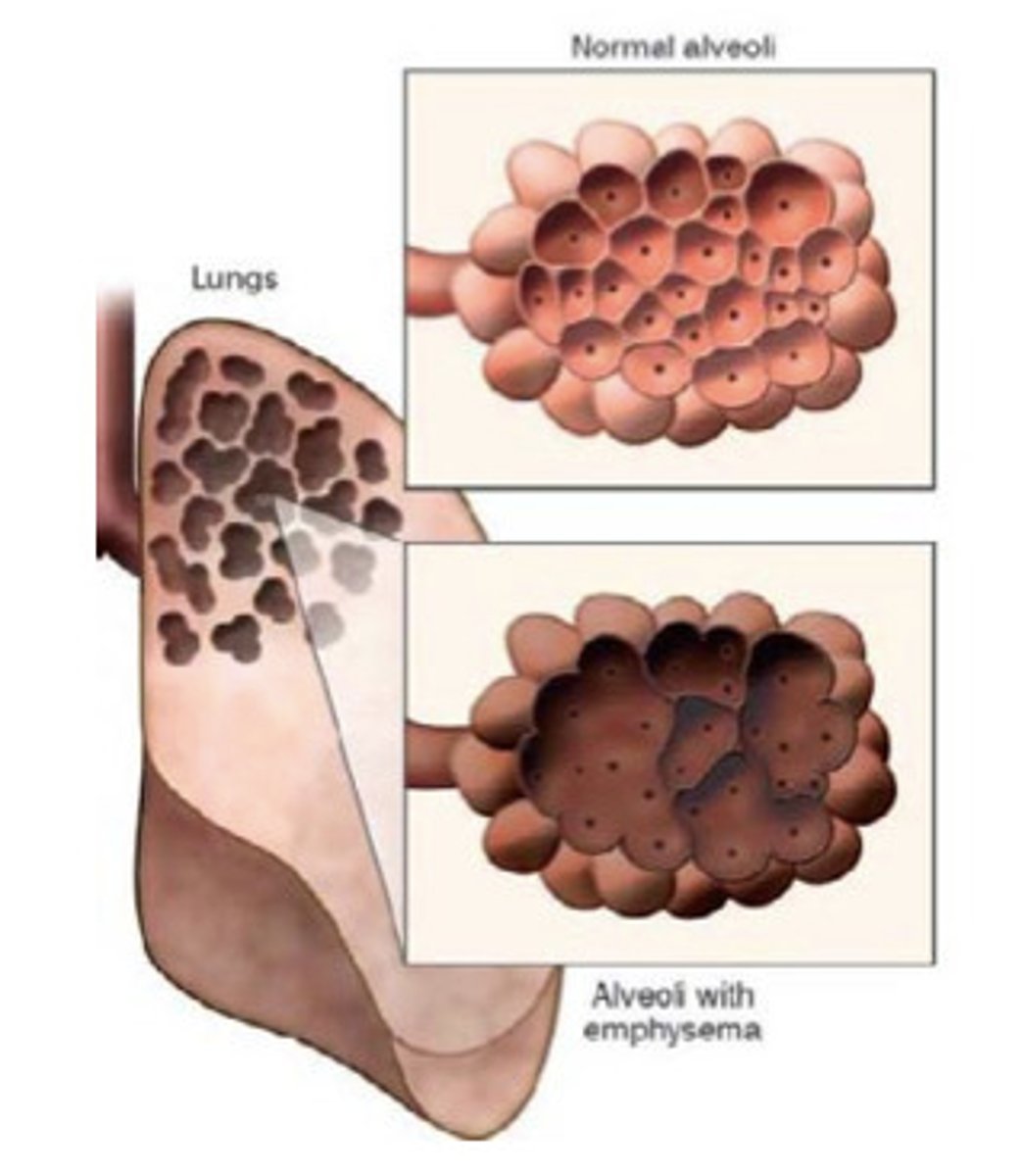 <p>Emphysema is a respiratory pathology that is defined as a(n)</p>