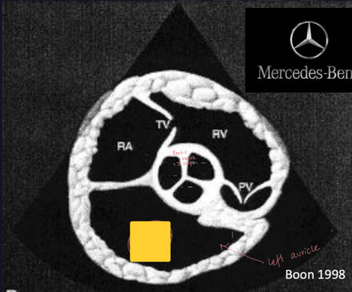 <p>Right Parasternal Short Axis View&nbsp;</p>