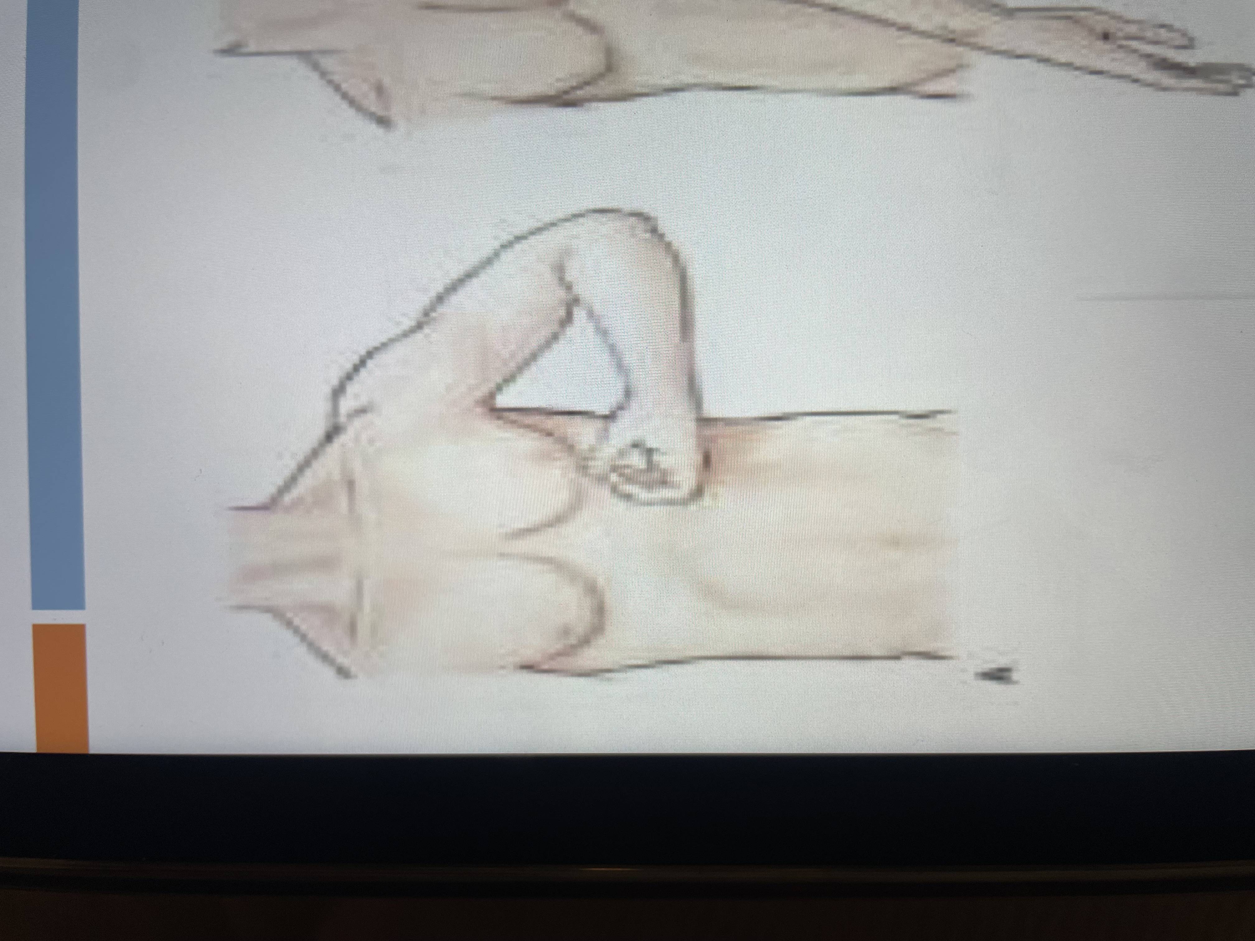 <p>upper flexion synergy</p>