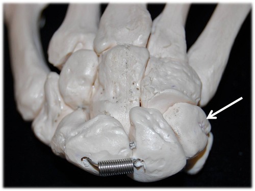 Name this specific bone of the hand (posterior view).