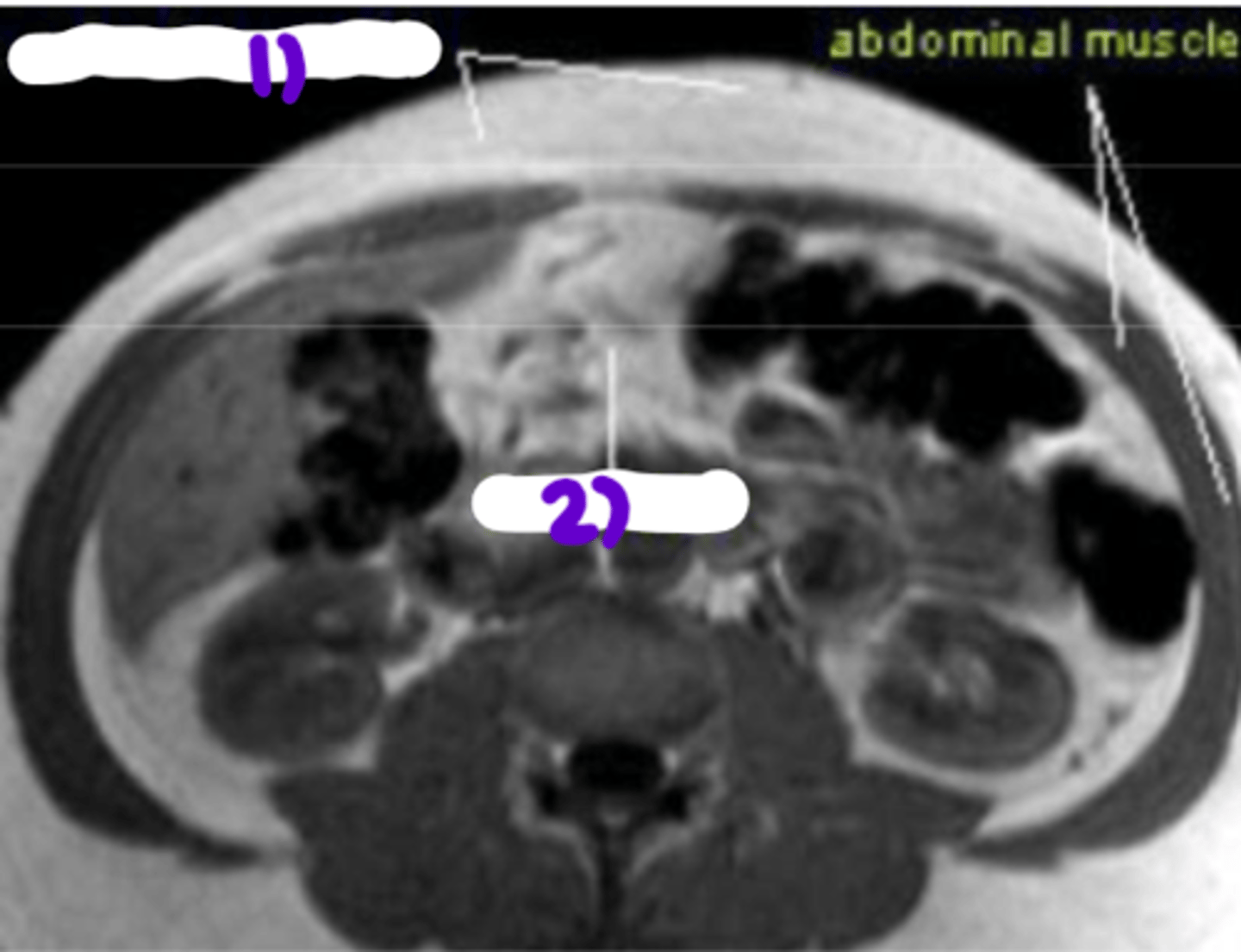<p>fat stored around the hips, thigs, or exterior of abdomen muscle</p>