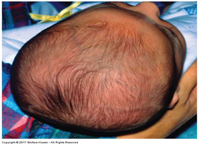 <p>What is asymmetry of the skull caused by the child lying on one side &amp; resolves when child becomes more active?</p>