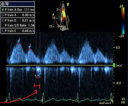 <p>peak systolic velocity (PVs)</p><p>peak diastolic velocity (PVd) </p><p>peak atrial reversal velocity (Pva) </p><p>duration of pulm vein atrial reversal (a-dur) </p>