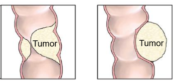 <p>intraluminal or extrinsic (mesentery growth) tumors</p><ul><li><p>GI or GYN origin</p></li></ul><p></p>