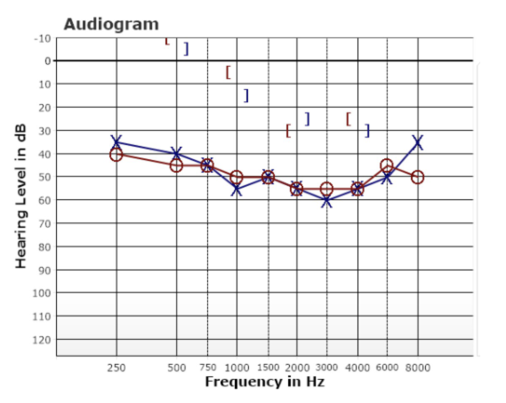 <p>How would you describe this audiogram?</p>