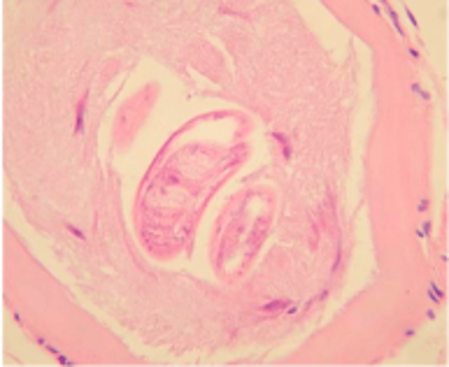 <p>Trichina Worm</p><p>-Larvae in edible tissue ingested in poorly cooked state</p><p>-Most current infection resulted from wild game (Bear)</p>