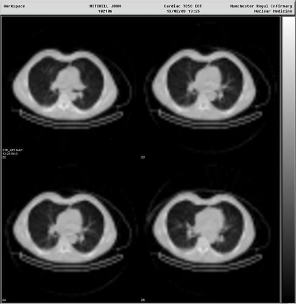 <p>SPECT imaging.</p>