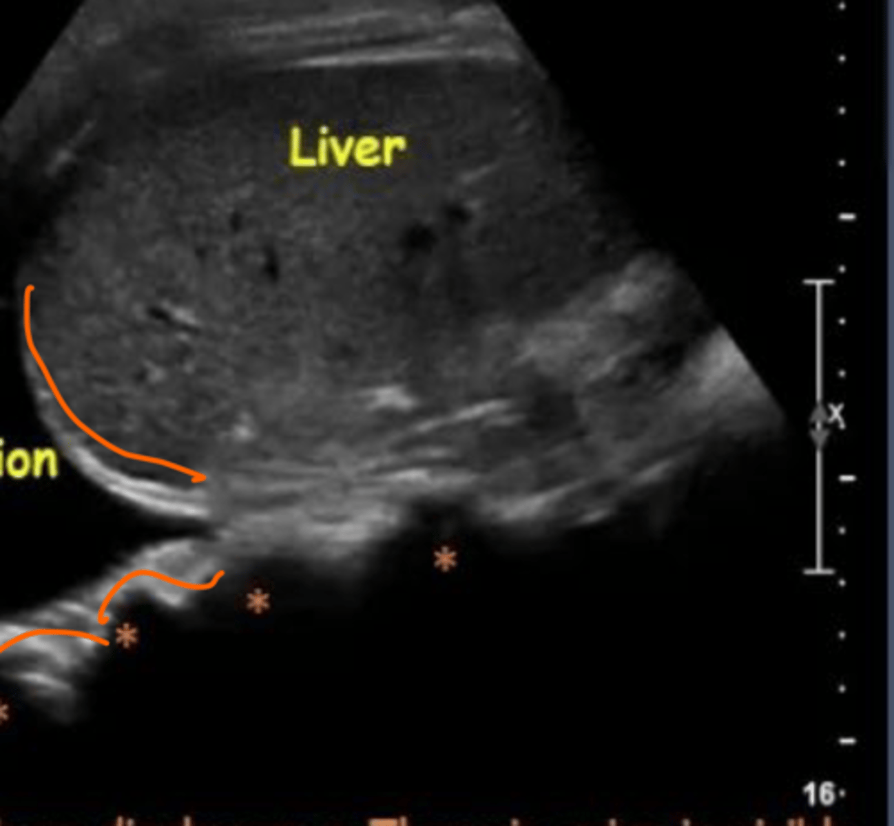 <p>this is a RUQ view, what is it showing and what is it indicative of</p>