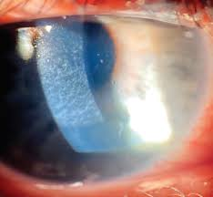 <p>Keratocytter ind i cornea (sårheling) </p><p>Optil 6mdr (men kan blive permanent grundet arvæv)</p>