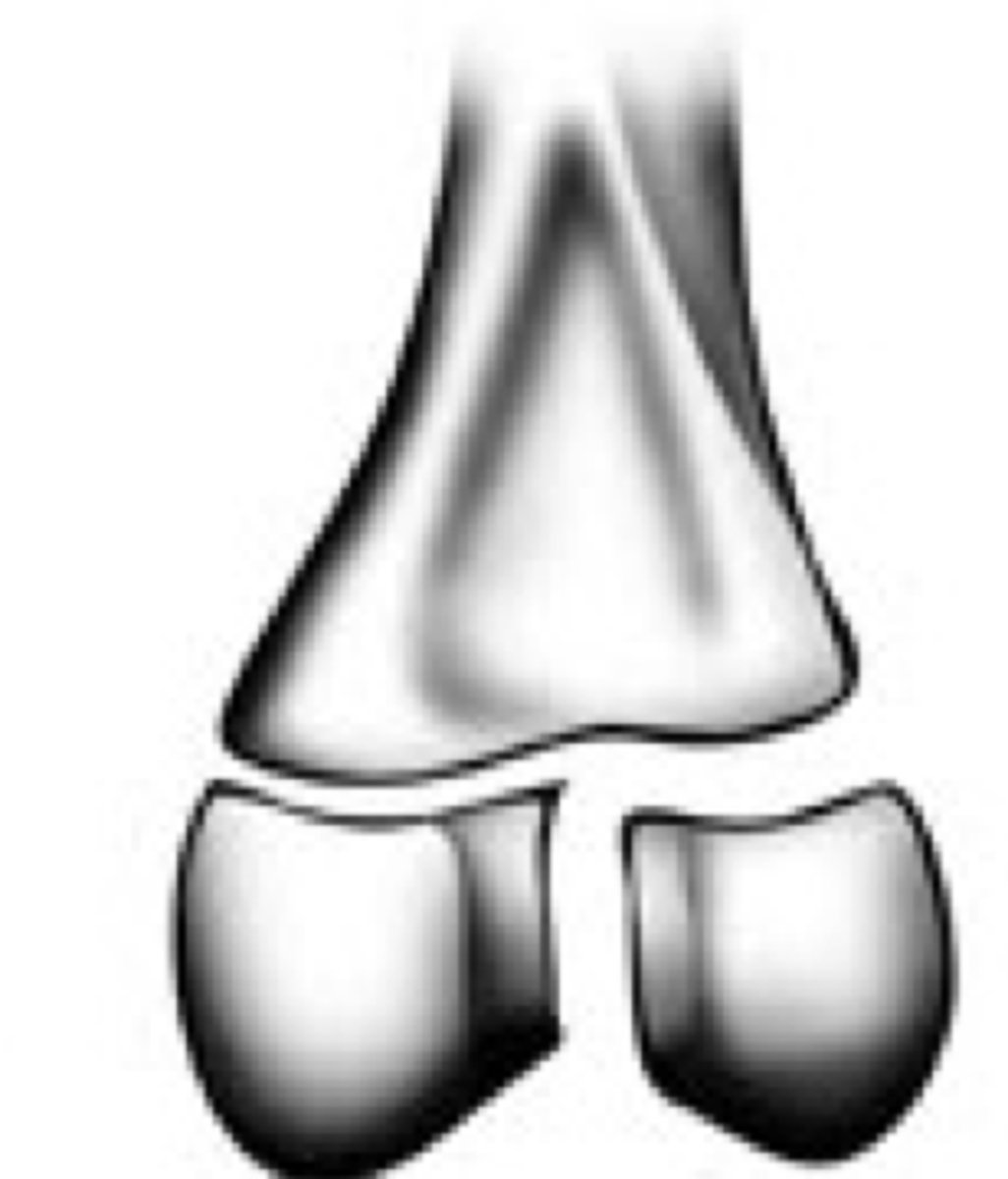 <p>Grade the Salter-Harris fracture?</p>