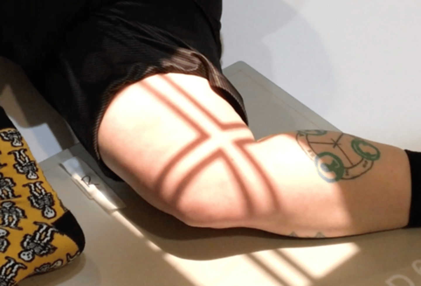 <p>Pt Placement: Supine lying on affected side with knee bent and other leg brought over the affected leg knee flexed 30 degrees, hips perpendicular</p><p>Collimation: Part size</p><p>CR Placement: On Medial condyle</p><p>Tube tilt: 5 degrees cephalic </p><p>SID: 40" tabletop</p><p>Breathing: DBDM</p>