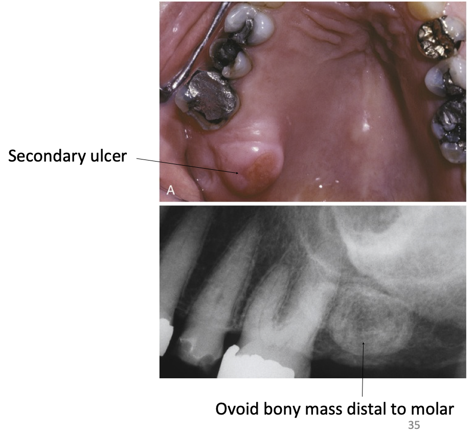 <ul><li><p class="p1"><strong>Location:</strong> Lingual aspect of maxillary tuberosities</p></li><li><p class="p1">Bilateral or unilateral</p></li><li><p class="p1">More common in males</p></li><li><p class="p1">Patients with buccal or palatal exostoses may also present <strong>palatal or mandibular tori</strong></p></li></ul><p></p>