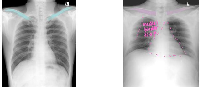 <p>Differentiate which is PA vs AP view. Why</p>