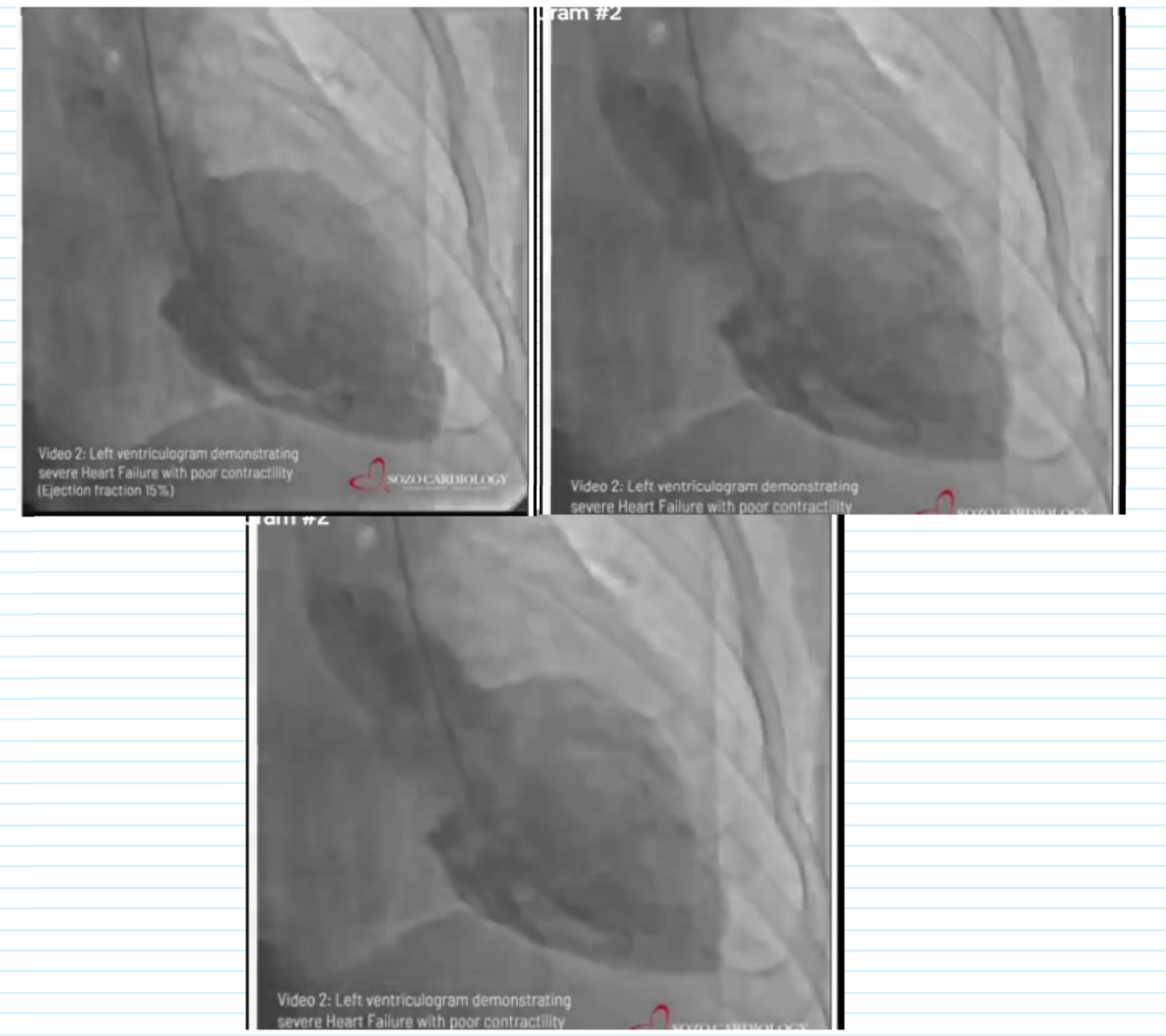 <ul><li><p>projection</p></li><li><p>Wall motion assessment</p></li><li><p>Estimated ejection fraction</p></li><li><p>Any valvular disease visualized</p></li></ul><p></p>