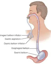 <ol><li><p>Esophagogastric <span style="color: rgb(189, 172, 10);"><strong>Balloon Tamponade</strong></span></p></li><li><p><span style="color: rgb(58, 183, 24);"><strong>Sclerotherapy </strong></span>(inject to shrink)</p></li><li><p>Ice <span style="color: rgb(96, 132, 229);"><strong>Saline lavage</strong></span> (to vasoconstrict)</p></li><li><p><span style="color: rgb(168, 104, 238);"><strong>Blood transfusions</strong></span></p></li><li><p><span style="color: rgb(252, 92, 195);"><strong>Banding </strong></span>(ligation)</p></li></ol><p></p>