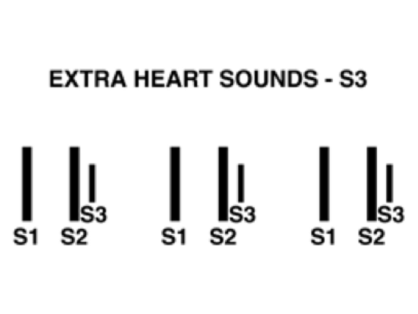 <p>(lub-dub-dub)—ventricular filling; early in diastole</p><p>Considered normal in healthy children and young adults*</p>