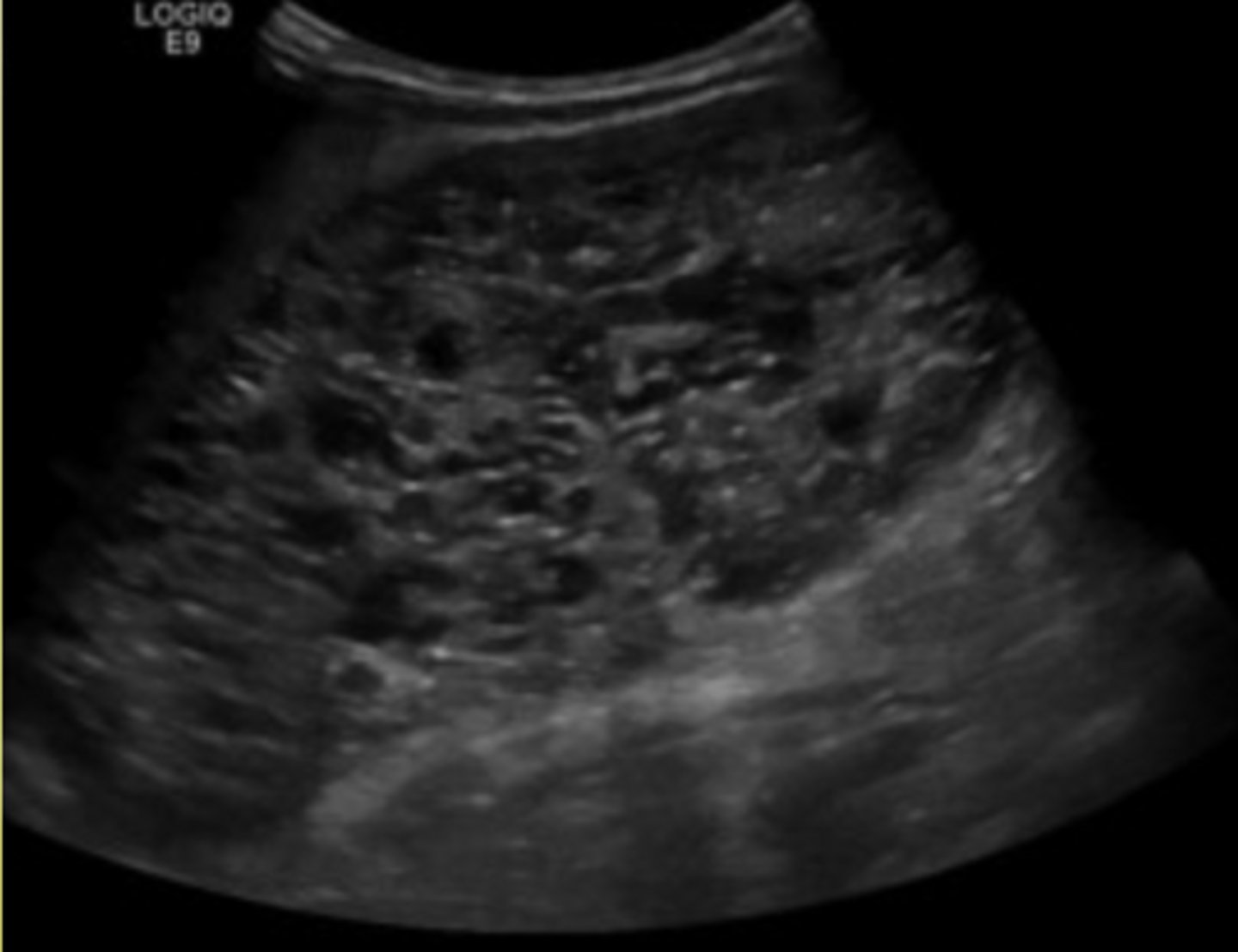 <p>If a patient has autosomal recessive polycystic kidney disease, what will the kidneys look like on ultrasound (Infantile)?</p>