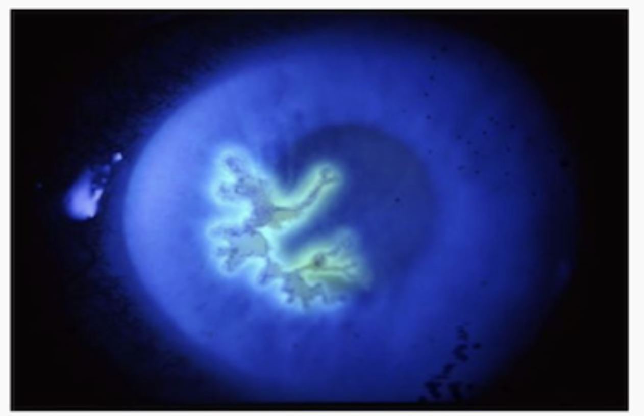 <p>Viral Keratitis</p>