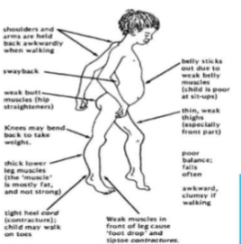 <p>progressive weakness</p><p>spinal deformity</p><p>pseudohypertrophy of calf muscles</p><p>cardiopulmonary involvement</p>