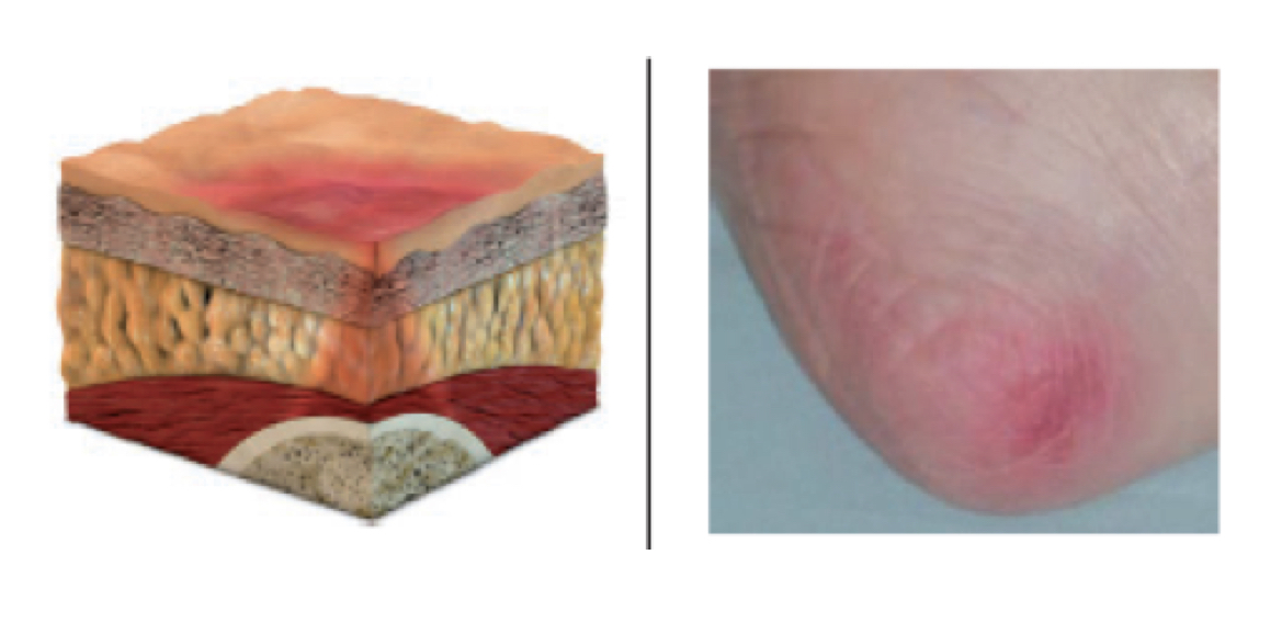 <ul><li><p>nonblanchable erythema of intact skin</p></li></ul>