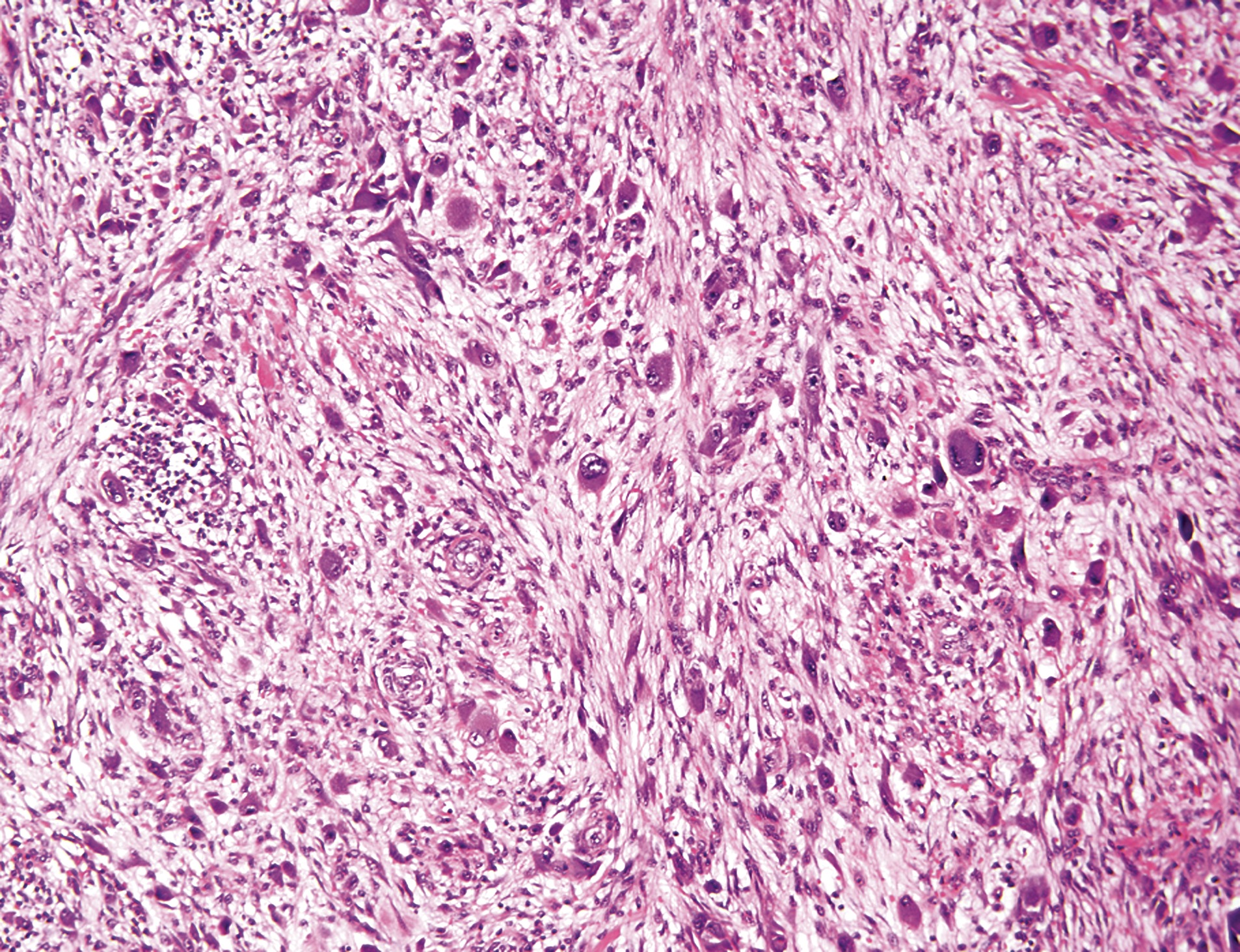 <p>Patient de 50 ans avec lésion du coude, sous cutané</p><p>1) Diagnostic&nbsp;</p><p>2) Epidemio (âge, fréquence par rapport à fascite nodulaire, localisation)</p><p>3) Histo</p><p>4) IHC</p>