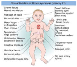 <p>The combined phenotypes that make up Down syndrome include:</p><ul><li><p>Mental retardation (with an IQ in the 20 to 50 range)</p></li><li><p>A broad, flat face</p></li><li><p>Eyes with an epicanthic fold (a skin fold of the upper eyelid that covers the inner corner of the eye)</p></li><li><p>Short stature</p></li><li><p>Short hands with a crease across the middle</p></li><li><p>A large, wrinkled tongue. </p><p></p></li></ul><p>Females may be fertile and may produce normal or trisomic progeny, but males are sterile with very few exceptions. </p><p>Due to improvements in the care of individuals with Down syndrome, the average life expectancy is now 60 years.</p>