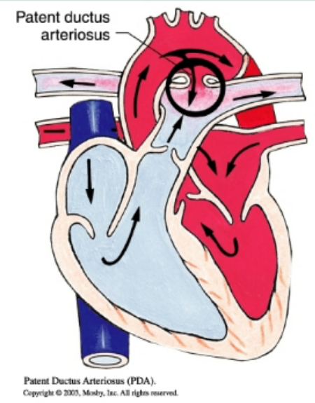 <p>opening between aorta and pulmonary artery so that oxygenated blood from aorta returns to the pulmonary artery and lungs causing pulmonary hypertension, “machine-like murmur”, indomethacin (NSAID inhibits synthesis of prostaglandin) or surgical intervention, increase risk for stroke, infection, and aneurysm, acyanotic&nbsp;</p>