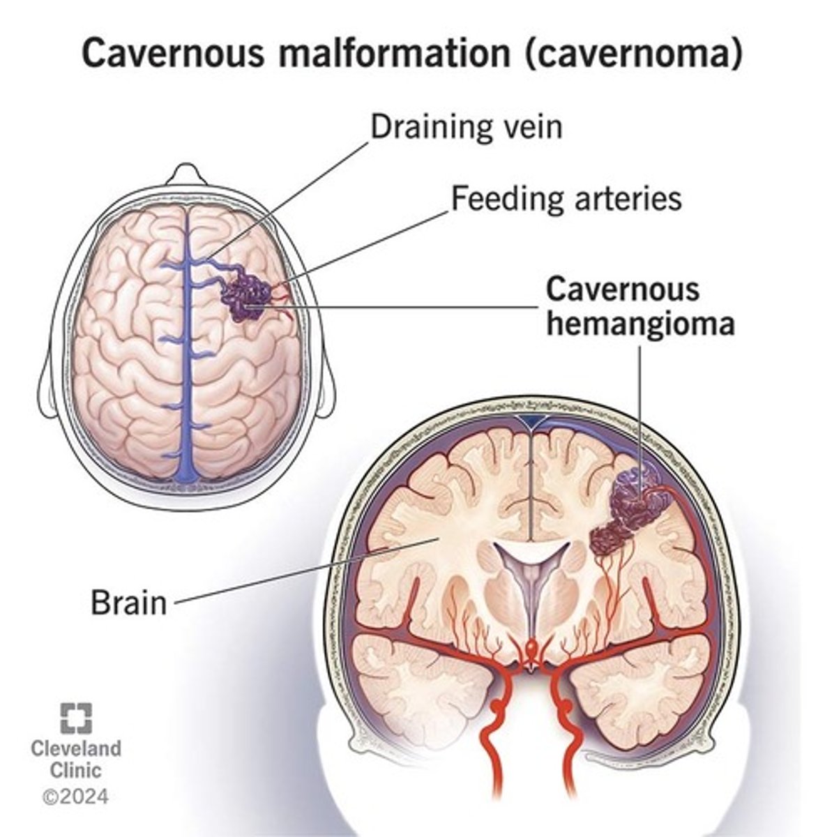 <p>- sponsachtige malformatie -> cystische casc ruimten</p><p>- aangeboren</p><p>- sec aan RT</p><p>- familiaal</p>