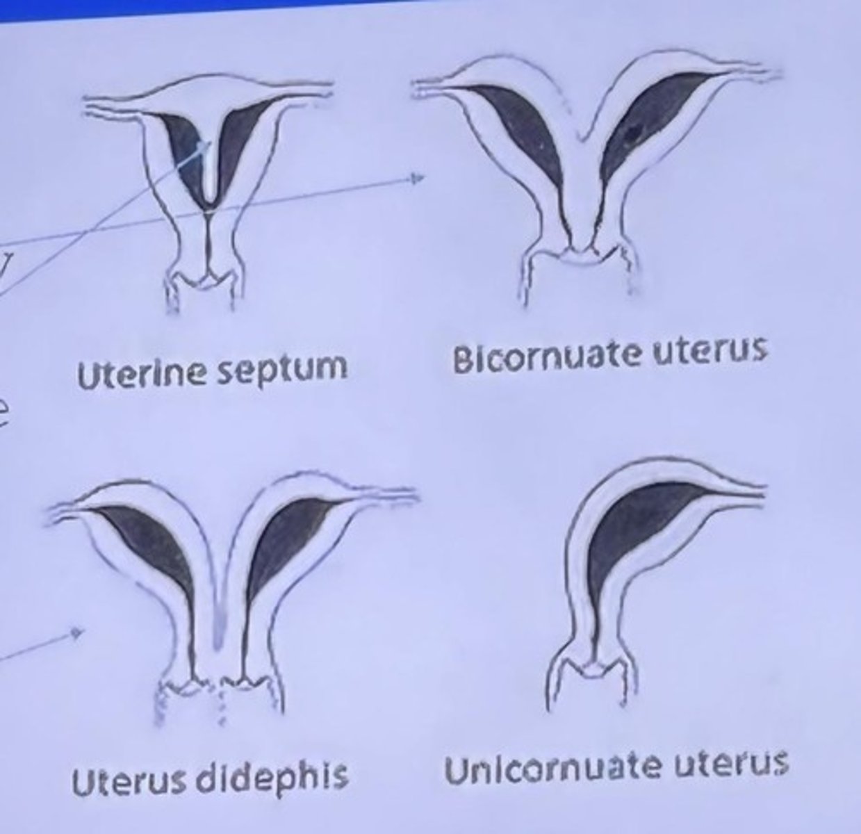 <p>Bicornuate uterus, septum dividing the uterus, and double uterus.</p>