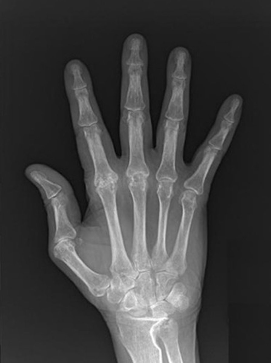 <p>what labs/tests are diagnostic for rheumatoid arthritis?</p>