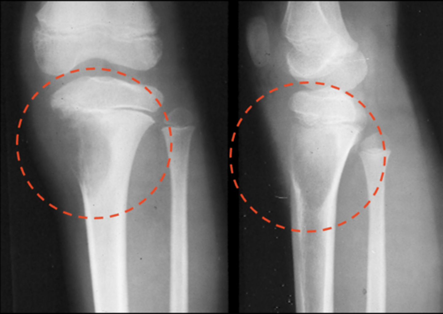 <p>ID type of osteosarcoma</p>
