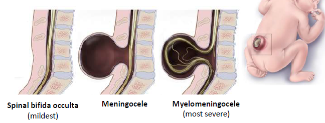 <ul><li><p>Results in missing backbone that normally protects</p></li></ul><p>the spinal cord and nerves</p><ul><li><p>Different types, ranging in severity</p></li></ul><p></p>