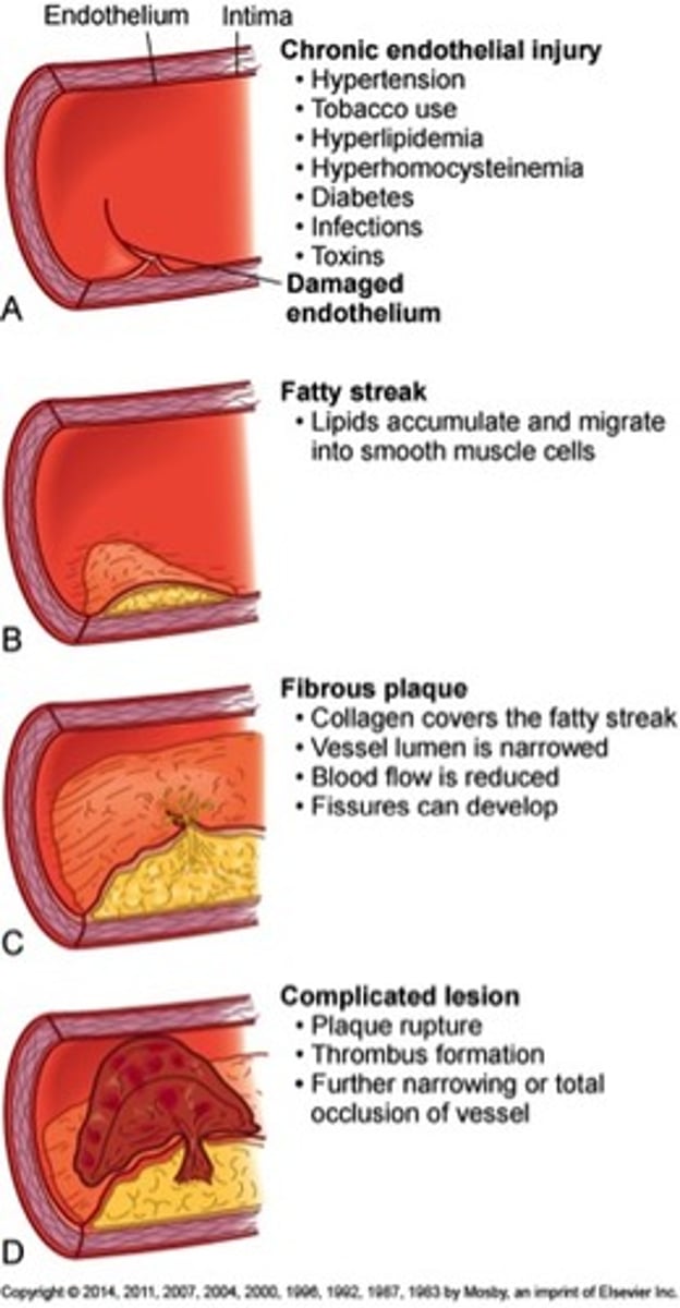 <p>Plaque buildup in arteries due to lipids</p>