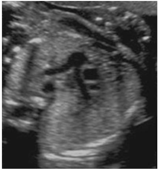 <p>where is the right pulmonary artery</p><p>type in “on the side of ascending AO”</p>