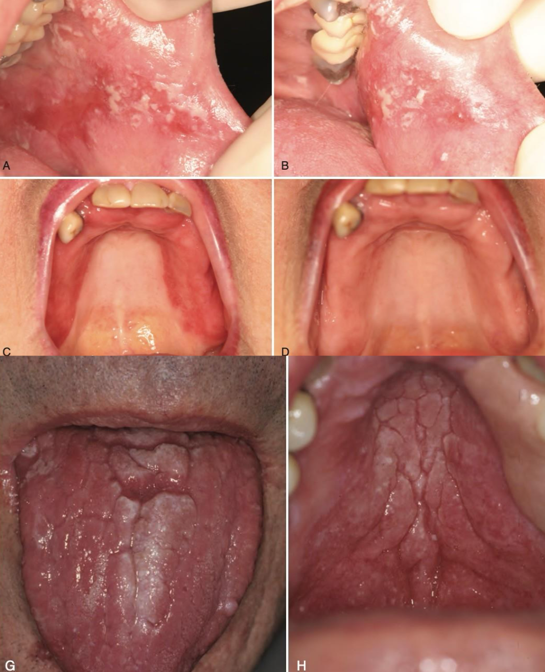 <p>which infectious lesion:</p><ul><li><p>Opportunistic fungal infection</p></li><li><p>Antibiotics, inhaled/topical steroids, immunosuppression, dry mouth, denture</p></li><li><p><strong>Clinical features:</strong></p><ul><li><p>Pseudomembranous</p></li><li><p>Erythematous</p></li><li><p>Hyperplastic</p></li></ul></li><li><p>Antifungals</p><ul><li><p>Nystatin suspension</p></li><li><p>Clotrimazole troches</p></li><li><p>Fluconazole</p></li></ul></li></ul><p></p>