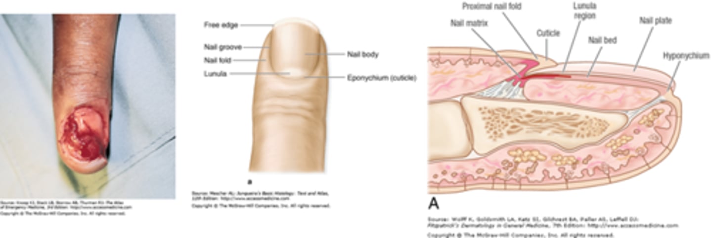 <p>Ensure distal phalanx is not fractured (if so, it is considered OPEN fracture)</p>