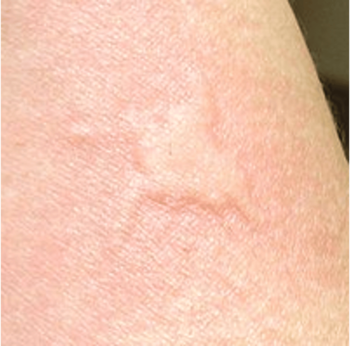 <p>A circumscribed, raised lesion consisting of dermal edema</p><p>- Ex: hives, mosquito bite</p>